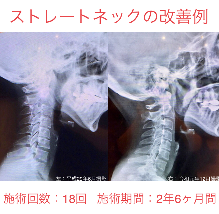 ストレートネックの改善例