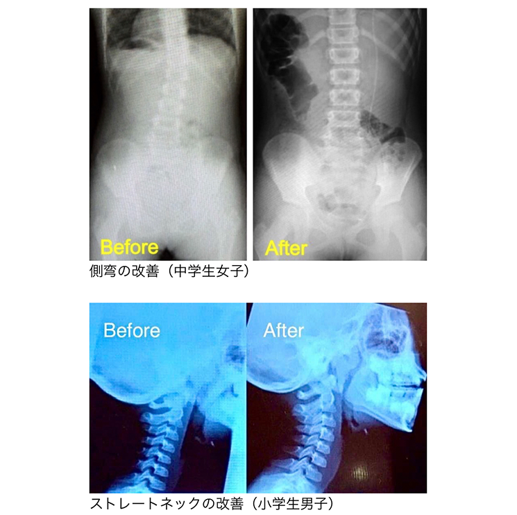 新生児カイロプラクティック