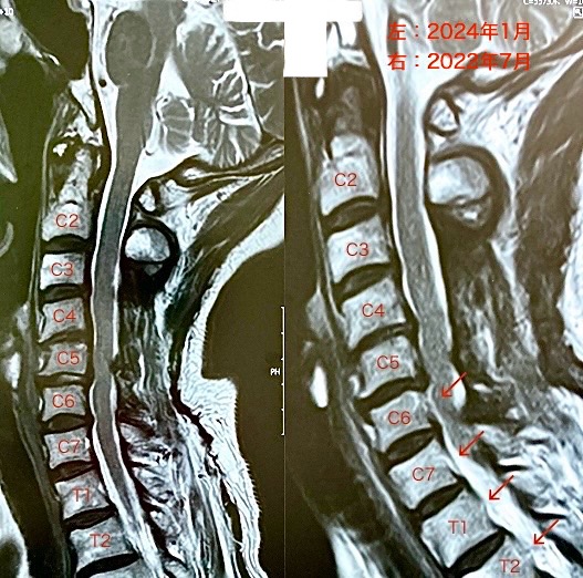 ［﻿手術回避！奇跡的な回復！「癒着（医師によるMRI診断）」による頚胸椎部可動性減少における難知性疾患が劇的に改善！］