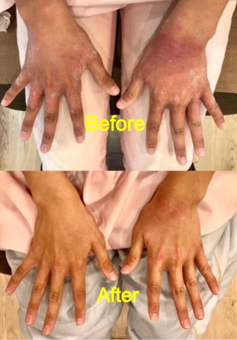 突如両手に現れた原因不明の皮膚疾患！が劇的に改善！